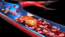 CHEST 2021 — La sarcoïdose pourrait être un facteur de risque de thromboembolie veineuse CHEST 2021 — La sarcoïdose pourrait être un facteur de risque de thromboembolie veineuse
