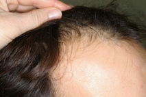 Alopécie androgénétique : une phase 3 confirme l’intérêt du finastéride topique Alopécie androgénétique : une phase 3 confirme l’intérêt du finastéride topique