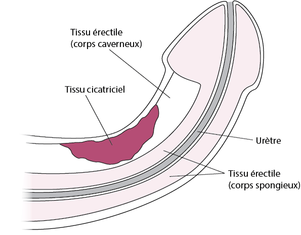 Dysfonction érectile : un impact négatif au-delà de la sphère sexuelle Dysfonction érectile : un impact négatif au-delà de la sphère sexuelle