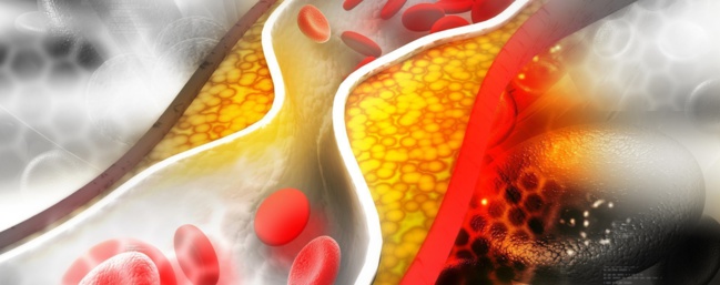 L’alirocumab stabiliserait la plaque d’athérome