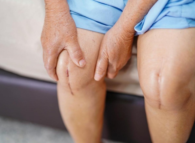 Les besoins non satisfaits en matière de soulagement de la douleur sont fréquents dans la population atteinte d’arthrose