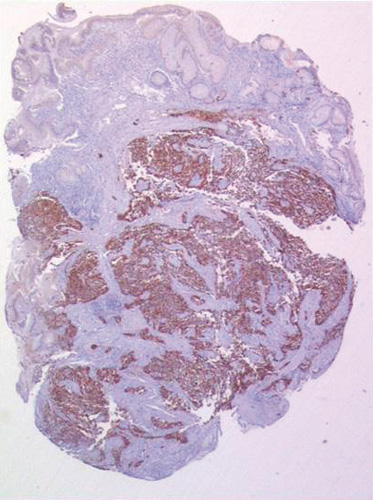 Une étude appuie la résection de la tumeur primitive dans le cadre du carcinome neuroendocrine gastrique de stade IV