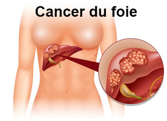 JFHOD 2023 : Le syndrome métabolique devenu deuxième cause de cancer du foie