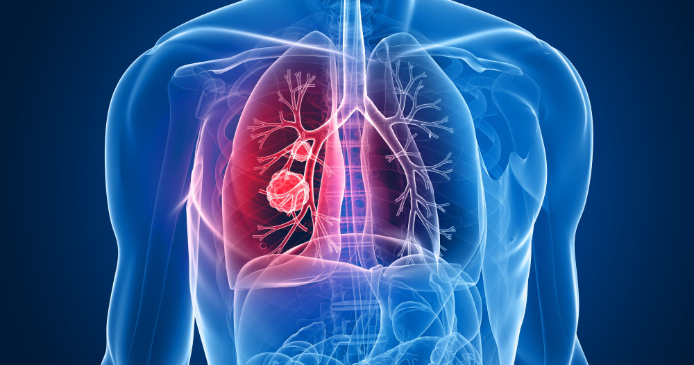 Le dépistage du cancer du poumon par une approche basée sur le risque est supérieur à l’approche catégorielle