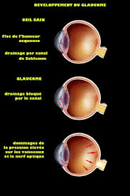 Glaucome à angle ouvert : et s’il fallait un traitement initial d’emblée intensif ?