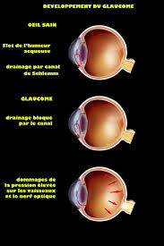 Glaucome à angle ouvert : et s’il fallait un traitement initial d’emblée intensif ? Glaucome à angle ouvert : et s’il fallait un traitement initial d’emblée intensif ?