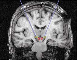 COVID-19 long et atteintes cérébrales : l’imagerie par PET-Scan pourrait lever le doute