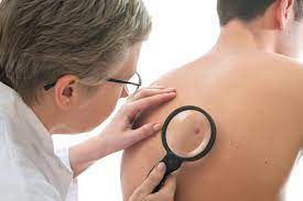 Un cancer de la peau à un âge avancé est associé à une maladie de peau rare liée à l’immunothérapie