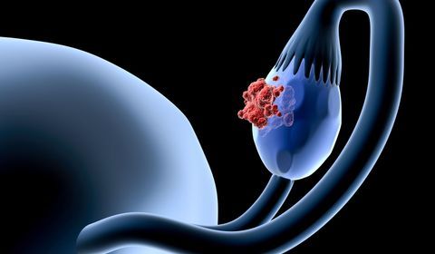 Cancer de l’ovaire : la chimiothérapie hebdomadaire à dose dense échoue lors d’un essai de phase III