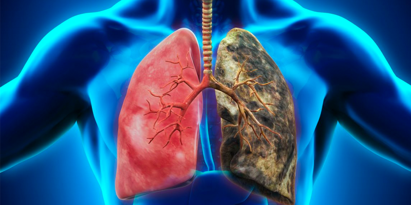 Quels sont les facteurs alimentaires qui influent sur le risque de cancer du poumon ? Une étude de 10 pays européens