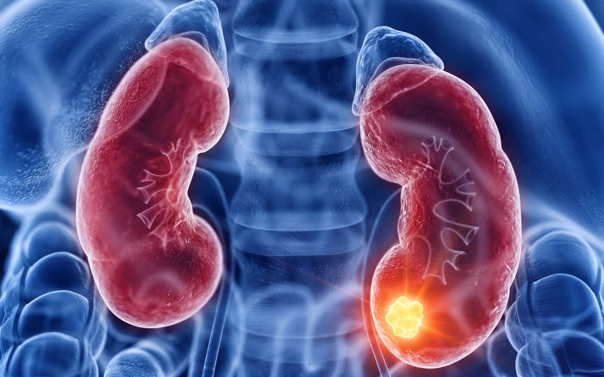 Cancer rénal : les combinaisons thérapeutiques complexifient la prise en charge des toxicités
