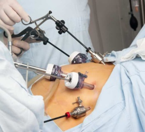 Chirurgie bariatrique : un risque significatif de résurgence du diabète à long terme