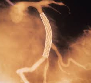 Les octogénaires atteints d’une maladie de l’artère coronaire complexe pourraient mieux se porter avec un pontage qu’avec une ICP