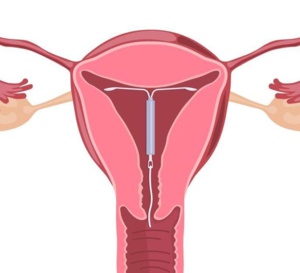 Avis des professionnels sur la pose de DIU en post-partum immédiat