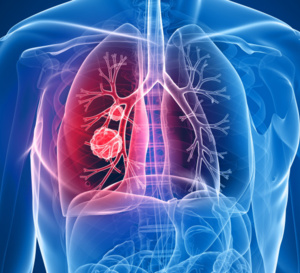 BPCO : la nouvelle prise d’une statine pourrait ne pas protéger contre les exacerbations