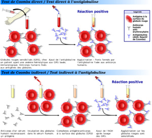 Les autoanticorps sont l’élément le plus prédictif d’un COVID long!