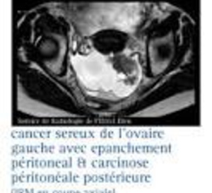 Tumeurs ovariennes à la limite de la malignité : la chirurgie avec préservation de l’utérus n’augmente pas le risque de mortalité
