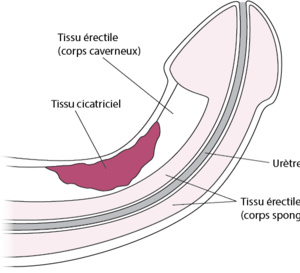 Dysfonction érectile : un impact négatif au-delà de la sphère sexuelle