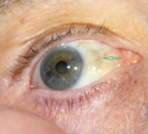 L’EMA recommande l’autorisation d’une nouvelle immunothérapie dans le cadre d’un mélanome uvéal rare