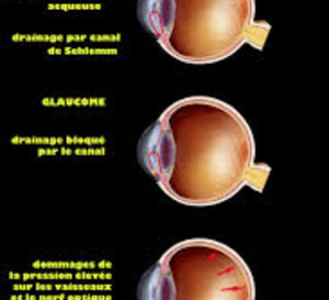 Glaucome à angle ouvert : et s’il fallait un traitement initial d’emblée intensif ?