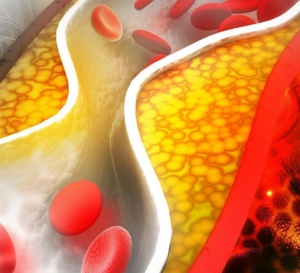 L’alirocumab stabiliserait la plaque d’athérome