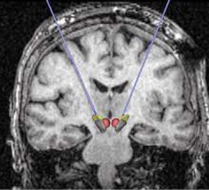 COVID-19 long et atteintes cérébrales : l’imagerie par PET-Scan pourrait lever le doute