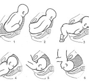 Quel type d’accouchement privilégier devant la présentation en siège du premier jumeau ?