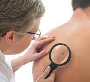 Un cancer de la peau à un âge avancé est associé à une maladie de peau rare liée à l’immunothérapie