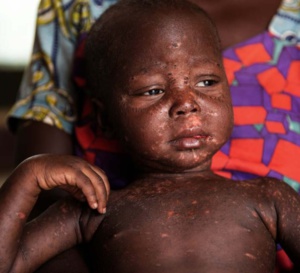 Vers une flambée épidémique de rougeole ?