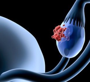   Une étude évalue le lien entre les inhibiteurs de la pompe à protons et le risque de cancer chez les femmes ménopausées