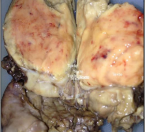 CCRm : les patients afro-américains présentent-ils un risque plus élevé de mortalité due à d’autres causes ?