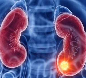Cancer rénal : les combinaisons thérapeutiques complexifient la prise en charge des toxicités