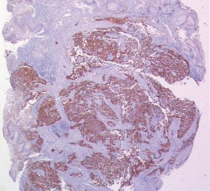 Une étude appuie la résection de la tumeur primitive dans le cadre du carcinome neuroendocrine gastrique de stade IV
