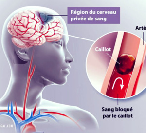 AVC (Accident Vasculaire Cérébral) : Causes, Symptômes et Traitements
