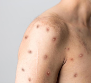 FAQ Monkeypox ou variole du singe : savoir repérer et orienter