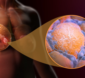Cancer du sein : quels sont les facteurs qui contribuent à un état de fatigue sévère un an après une radiothérapie ?