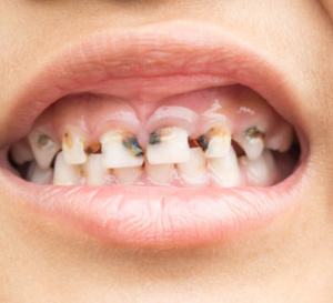  Bambey affiche une "forte prévalence" de la carie dentaire chez les enfants (médecin)