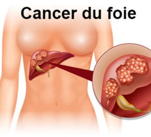 JFHOD 2023 : Le syndrome métabolique devenu deuxième cause de cancer du foie