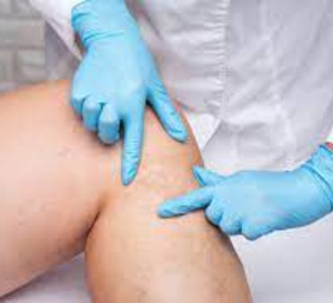 Limiter les conséquences de la maladie artérielle périphérique par l’exercice à domicile