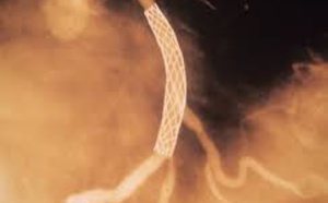 Les octogénaires atteints d’une maladie de l’artère coronaire complexe pourraient mieux se porter avec un pontage qu’avec une ICP Les octogénaires atteints d’une maladie de l’artère coronaire complexe pourraient mieux se porter avec un pontage qu’avec une ICP