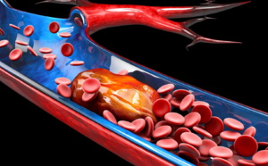 CHEST 2021 — La sarcoïdose pourrait être un facteur de risque de thromboembolie veineuse