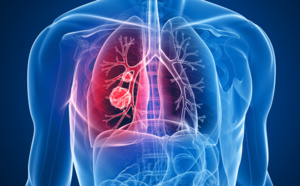 Le dépistage du cancer du poumon par une approche basée sur le risque est supérieur à l’approche catégorielle