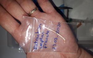 L’implant contraceptif: Quels sont les avantages et les inconvénients ?