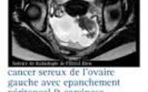 Tumeurs ovariennes à la limite de la malignité : la chirurgie avec préservation de l’utérus n’augmente pas le risque de mortalité Tumeurs ovariennes à la limite de la malignité : la chirurgie avec préservation de l’utérus n’augmente pas le risque de mortalité