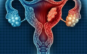 cancer du col de l utérus