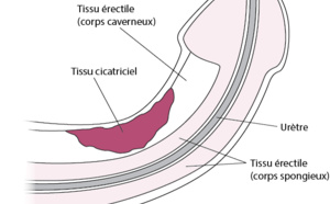 Dysfonction érectile : un impact négatif au-delà de la sphère sexuelle