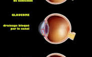 Glaucome à angle ouvert : et s’il fallait un traitement initial d’emblée intensif ? Glaucome à angle ouvert : et s’il fallait un traitement initial d’emblée intensif ?