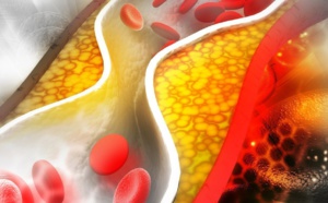 L’alirocumab stabiliserait la plaque d’athérome