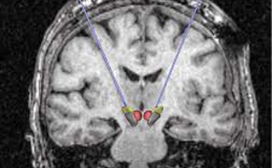 COVID-19 long et atteintes cérébrales : l’imagerie par PET-Scan pourrait lever le doute