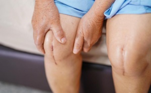 Les besoins non satisfaits en matière de soulagement de la douleur sont fréquents dans la population atteinte d’arthrose